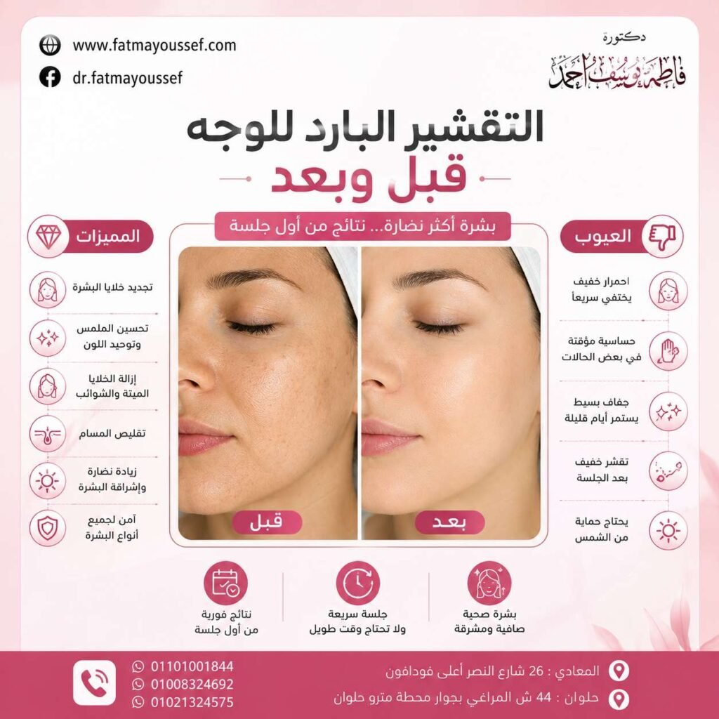 التقشير البارد للوجه قبل وبعد