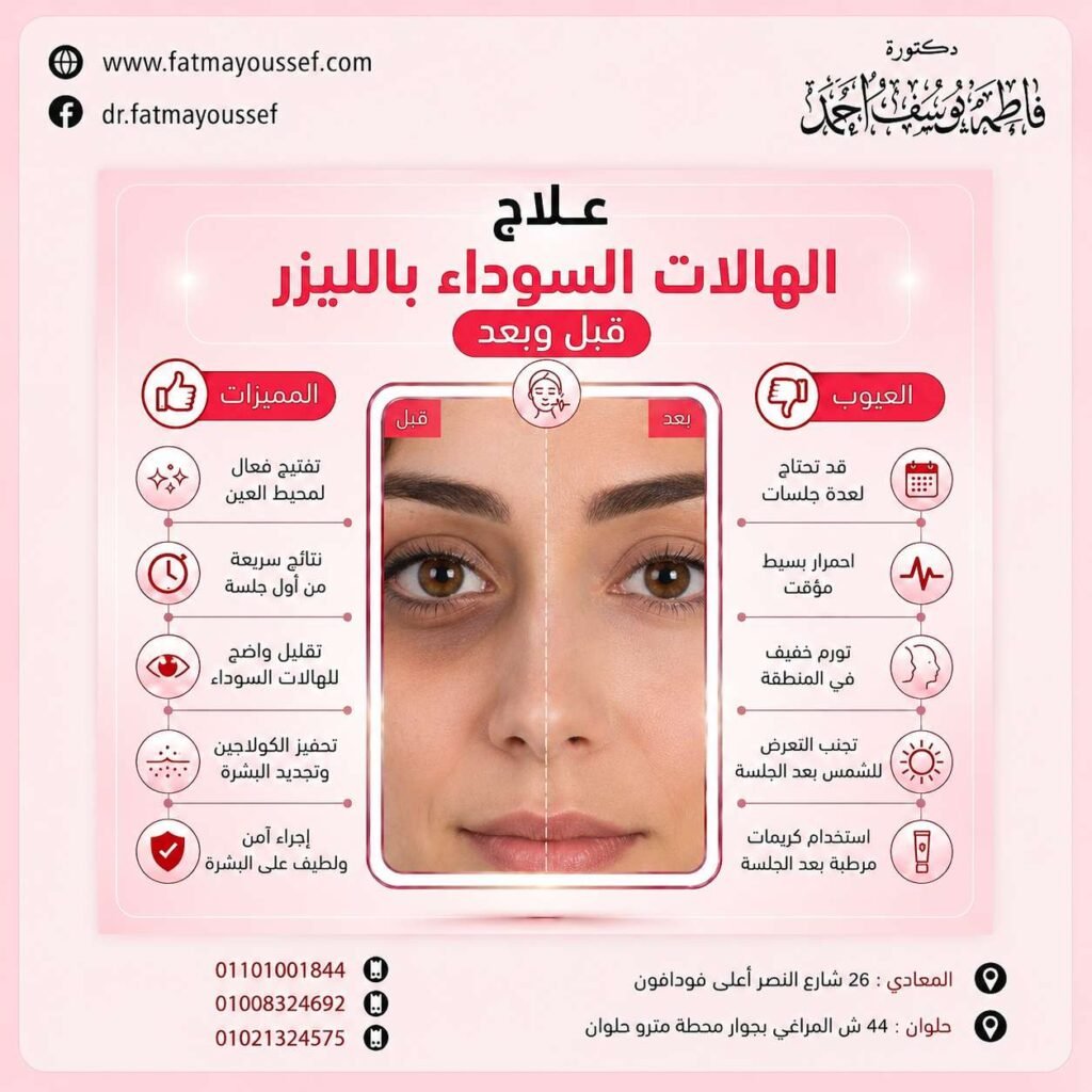 علاج الهالات السوداء بالليزر قبل وبعد
