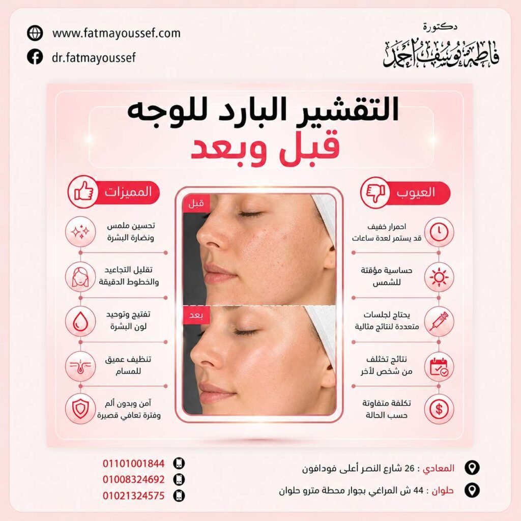 التقشير البارد للوجه قبل وبعد
