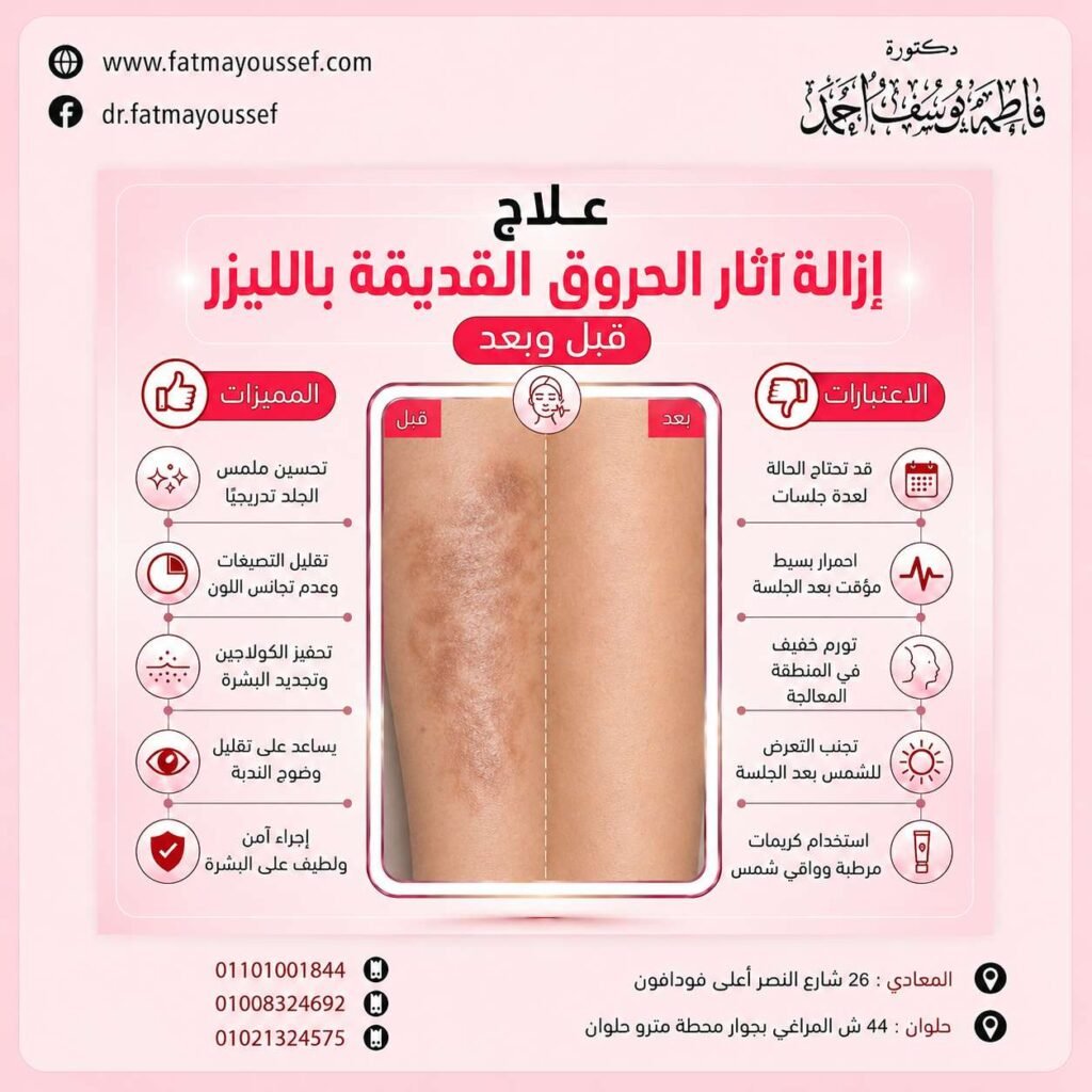 إزالة آثار الحروق القديمة بالليزر