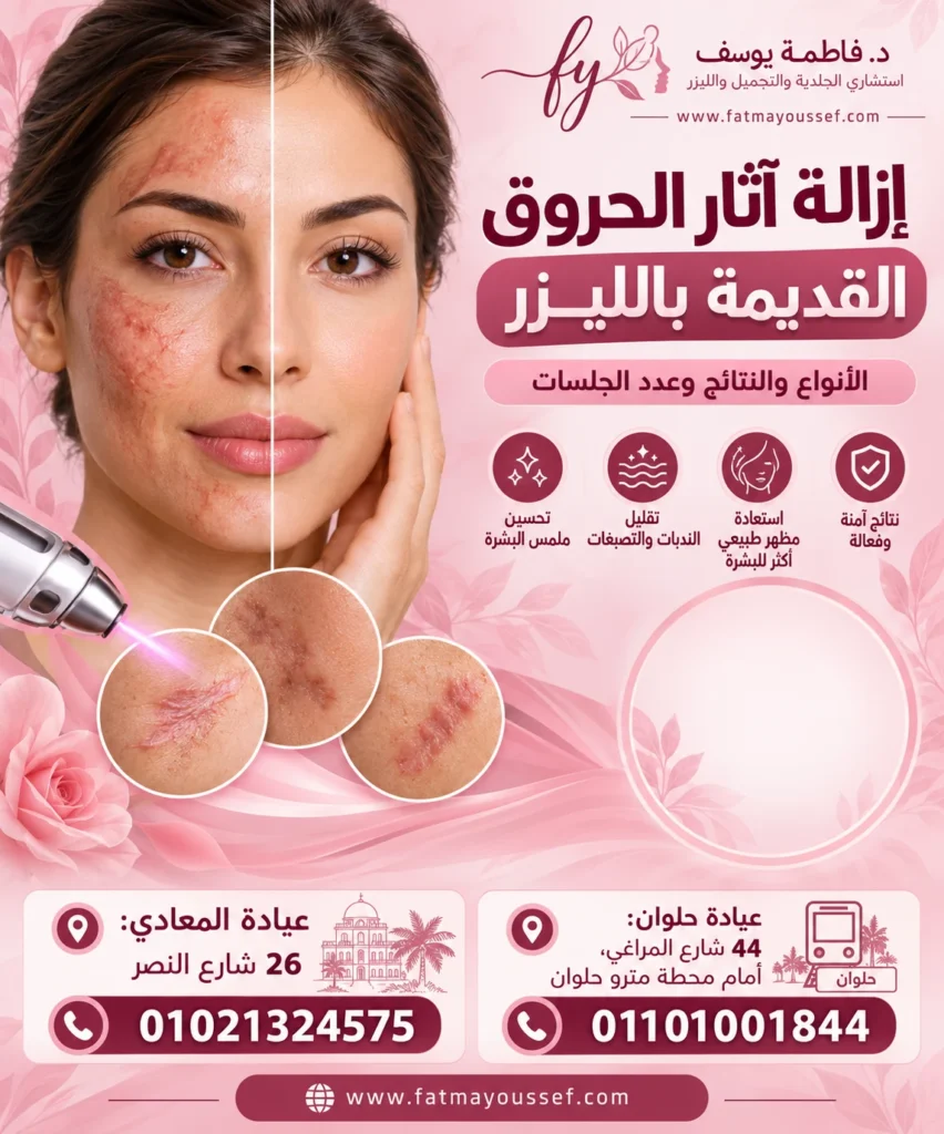 إزالة آثار الحروق القديمة بالليزر