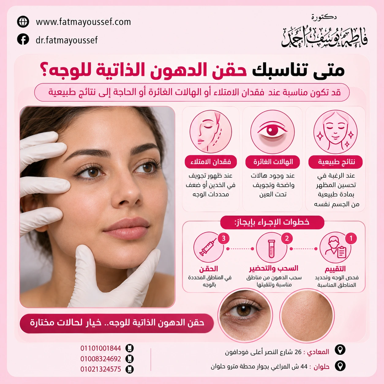 رسم توضيحي لحقن الدهون الذاتية للوجه ومناطق استعادة الحجم في الخدود وتحت العين